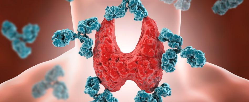 Schilddrüsenerkrankung: Was ist Hashimoto-Thyreoiditis?