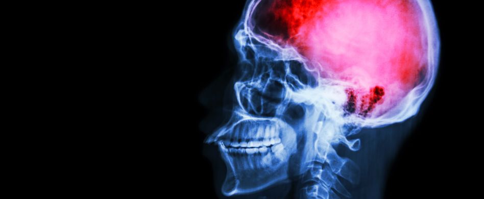 Schlaganfall-Folgen: Warum sie so unterschiedlich sind