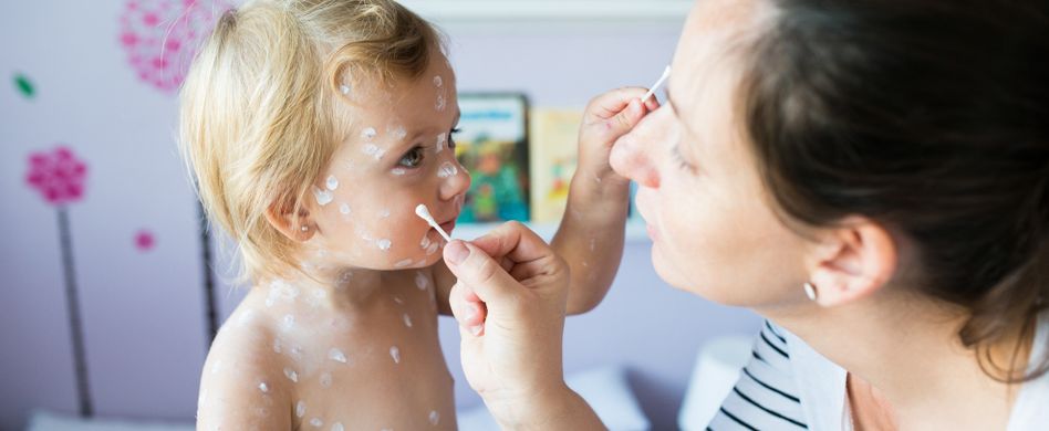 Sind Windpocken bei Erwachsenen wirklich so gefährlich?