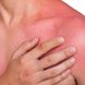 Starker Sonnenbrand - wann zum Arzt?
