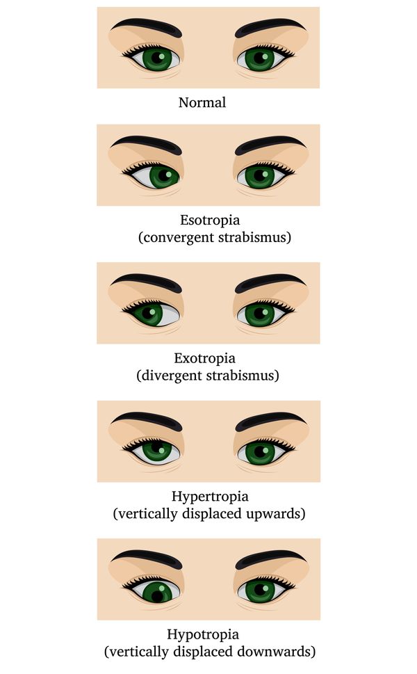 strabismus-formen-ursachen-behandlung-von-schielen-bild-2