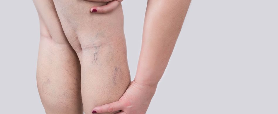 Thrombose erkennen: Auf diese Symptome sollten Sie achten