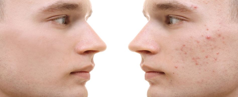 Vitamin B5 gegen Akne und Haarausfall? Ein Hautarzt klärt auf