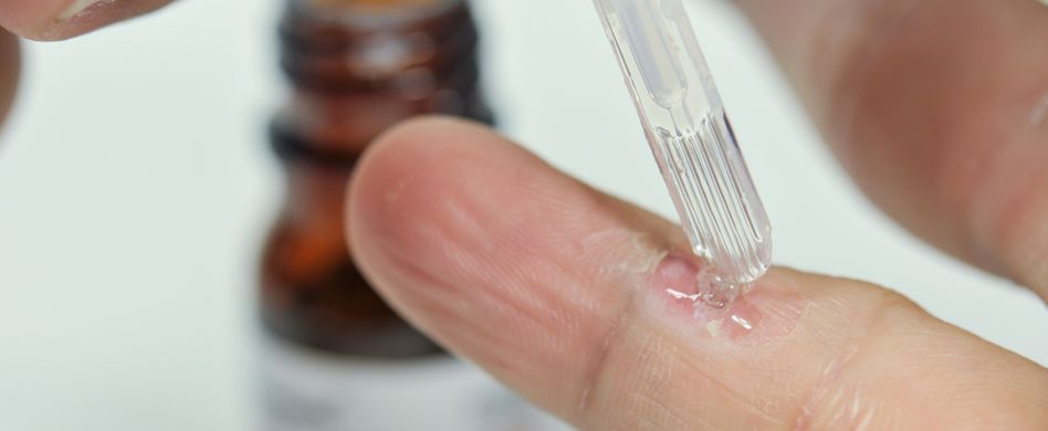 Warzen behandeln: Was gegen die Hornhautwucherung hilft