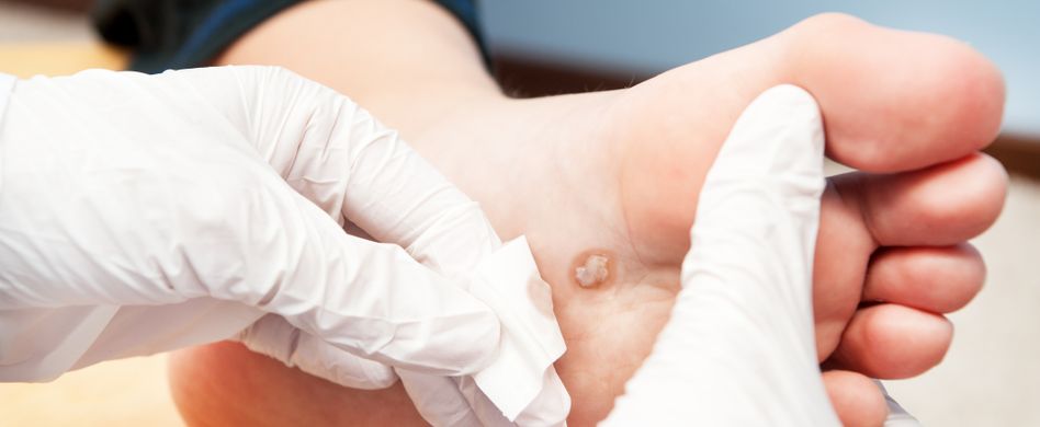 Warzen (Verrucae): HPV-Viren lösen Warzen aus