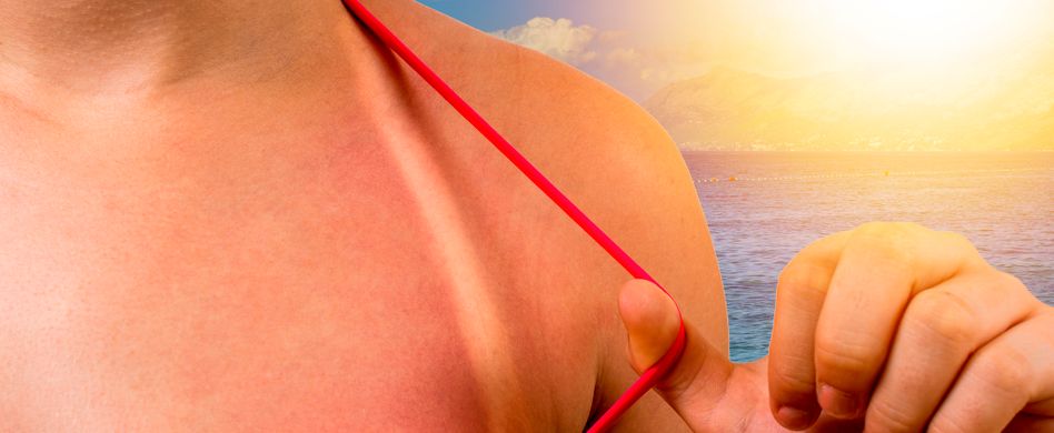 Was ist eine Sonnenallergie?