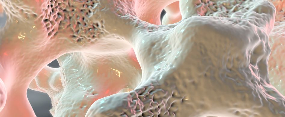 Was ist Osteoporose?