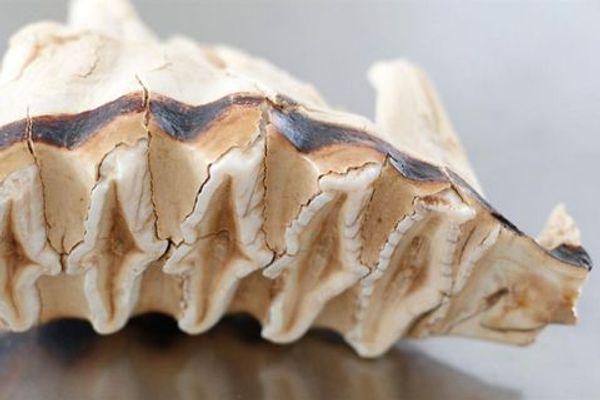 was-sie-vor-ihrer-weisheitszahnentfernung-wissen-sollten-bild-1