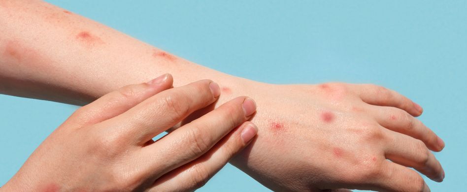 Was sind Affenpocken und sind sie gefährlich?