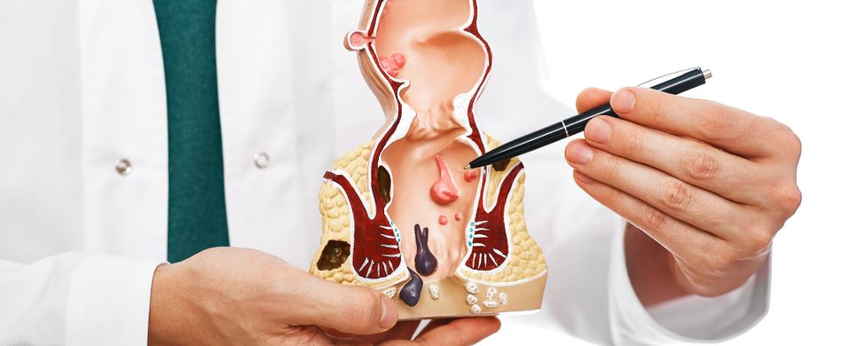 Hämorrhoiden Modell
