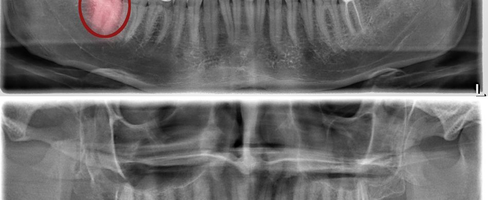 Wie entstehen Zahnschmerzen?