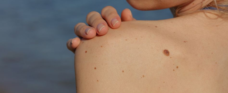 Wie entsteht ein Leberfleck?