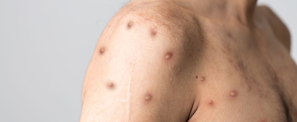 Wie werden Affenpocken übertragen?