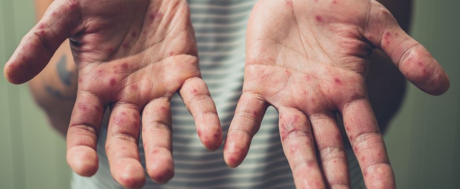 Windpocken (Varizellen): Symptome, Behandlung & Windpocken-Impfung