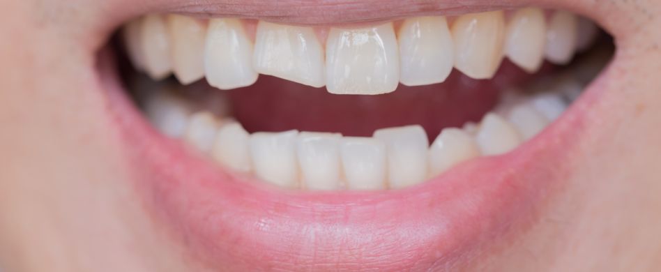 Zahn abgebrochen - was tun?