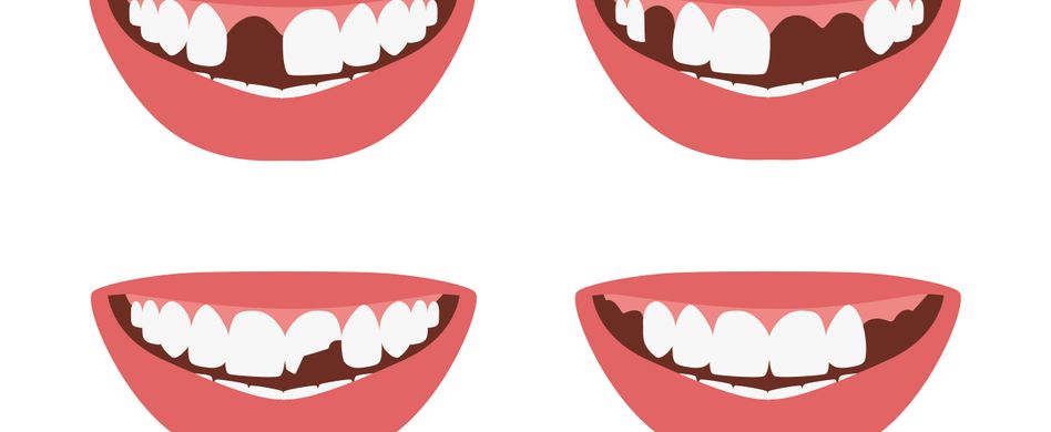 Zahnlücke: häufige Ursachen & Behandlung