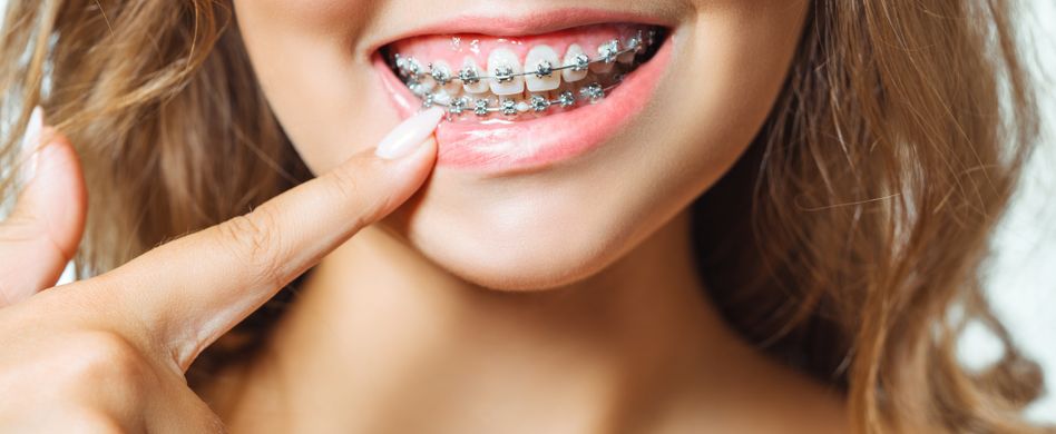 Zahnspange: Der Weg zum geraden Lächeln