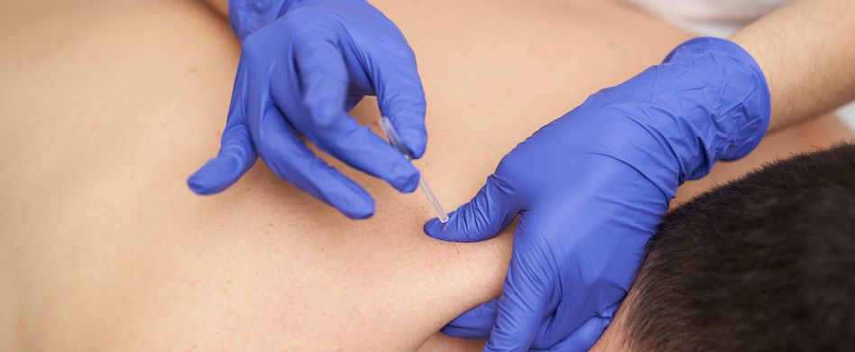 mann wird von person mit blauen handschuhen mit akupunkturnadeln behandelt