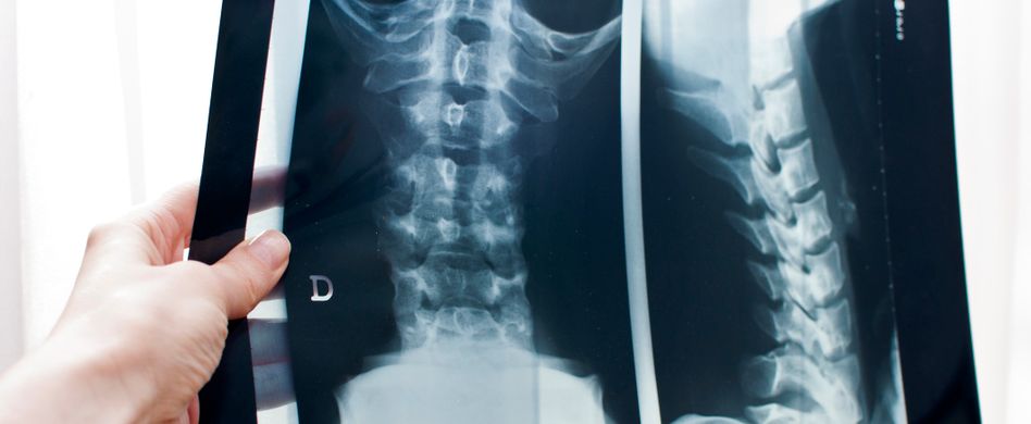 Bandscheibenvorfall: Therapie des schmerzhaften Rückenleidens