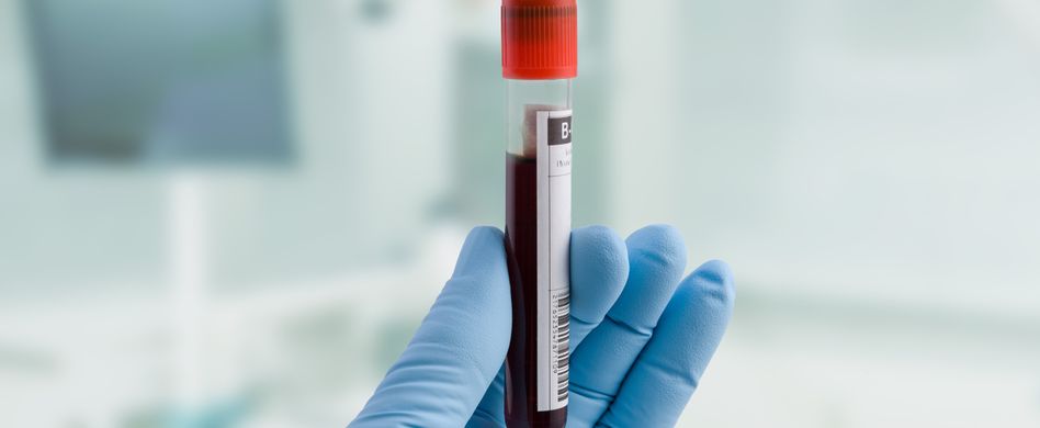 Bluttests zur Krebsfrüherkennung: Kann ein Bluttest Krebs erkennen?