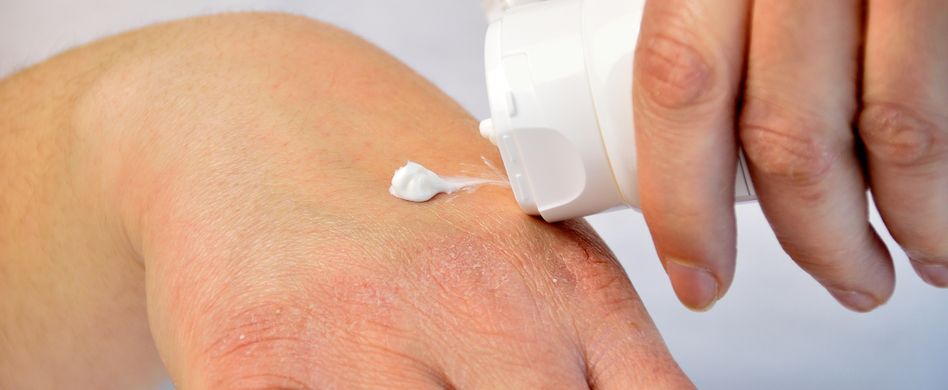 Ekzem behandeln: Therapiemöglichkeiten für die entzündete Haut