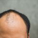 Erblich bedingter Haarausfall: Was ist androgenetische Alopezie (AGA)?