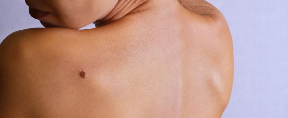 Hautkrebs behandeln: Wie heilbar ist Hautkrebs?