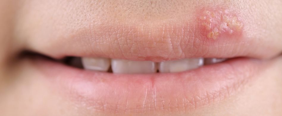 Herpes-Symptome: So zeigt sich Herpes an der Lippe