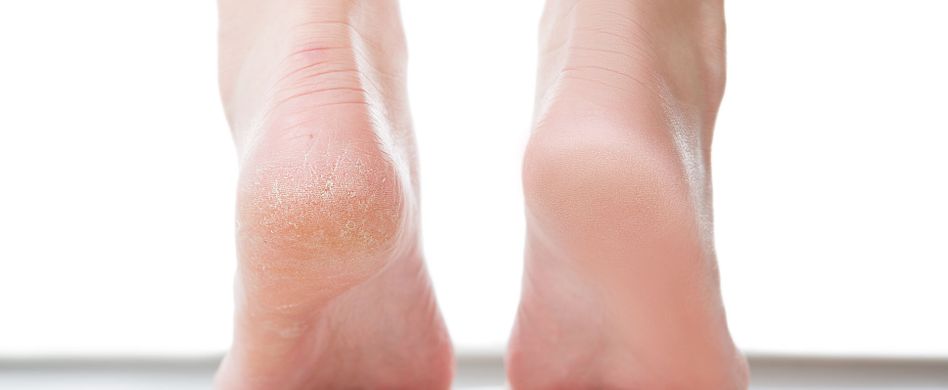 Hyperkeratose am Fuß: Ursache und Behandlung der Verhornung