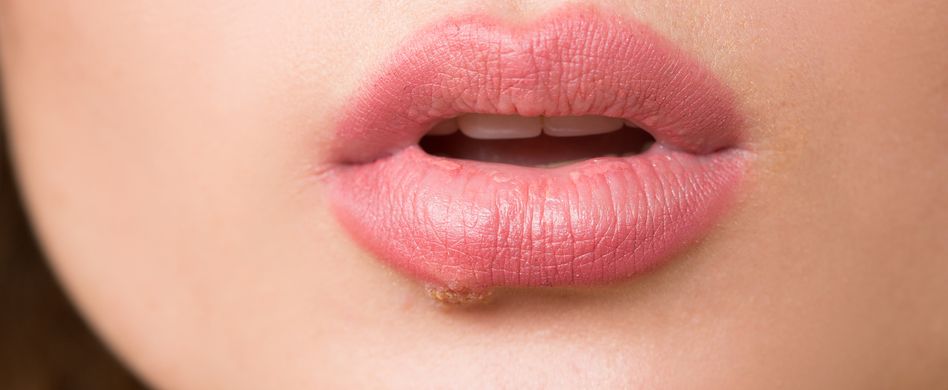 Lippenherpes: Fast jeder hat das Herpes-Virus