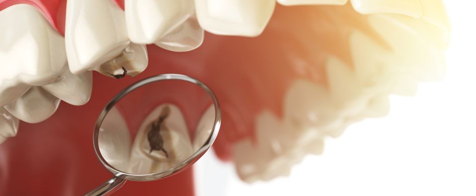 Loch im Zahn: Darum verursacht Karies Zahnschmerzen
