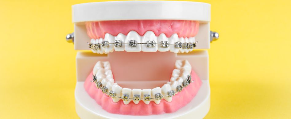 Lose, fest, um den Kopf: Welche Zahnspangen gibt es?