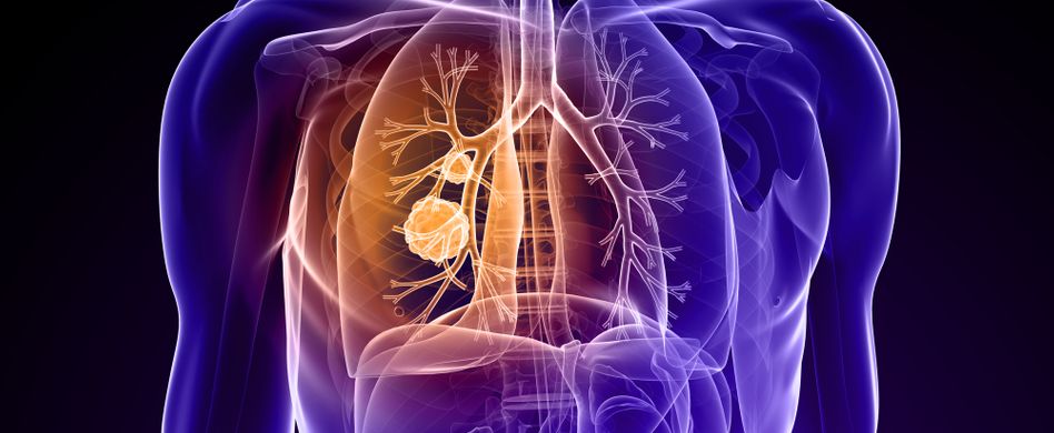 Lungenkrebs: 5 Fakten zum Krebs in der Lunge
