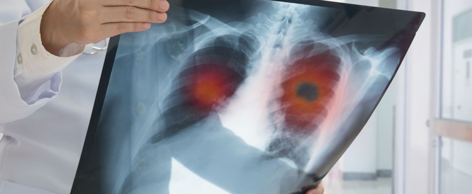 Lungenkrebs behandeln: Wie gut ist Lungenkrebs heilbar?