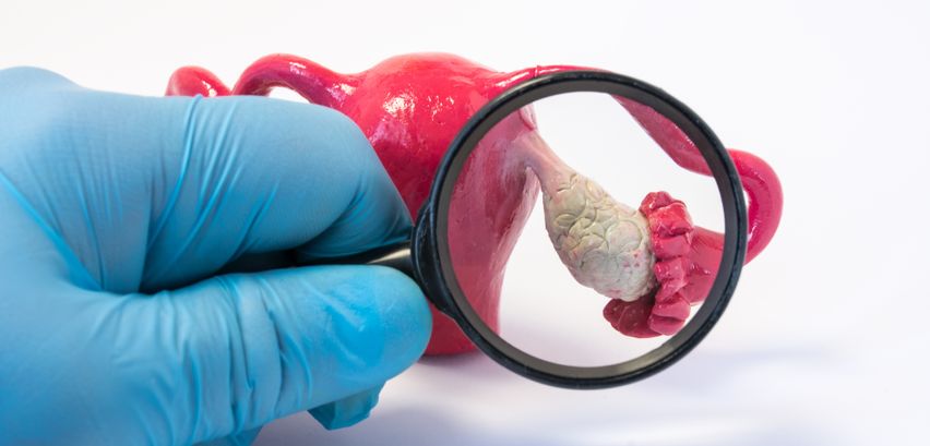 PCOS Behandlung PCOS Behandlung