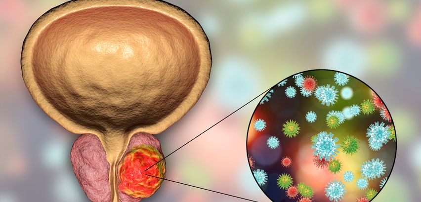 PSA-Test beim Urologen: Gibt er Hinweise auf Prostatakrebs?