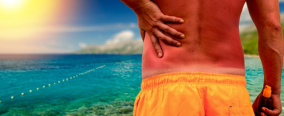 Sonnenbrand-Symptome: Warum juckt und schmerzt Sonnenbrand?