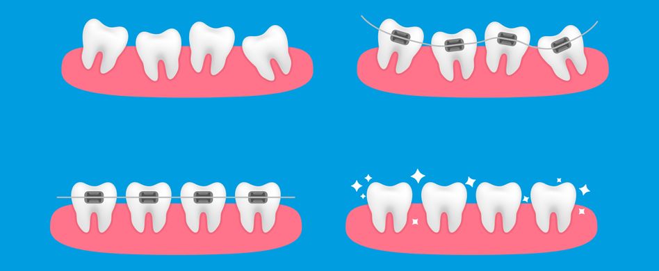 Symptome bei Kiefer- und Zahnfehlstellungen: Diese Probleme können auftreten