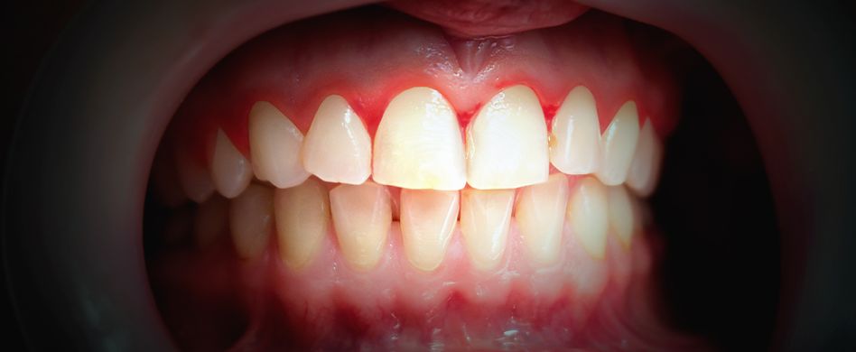 Was ist Parodontose? Ursachen, Symptome und Behandlung der Zahnfleischerkrankung