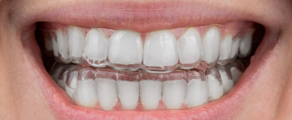 Was sind Fehlstellungen im Zahn- und Kieferbereich?