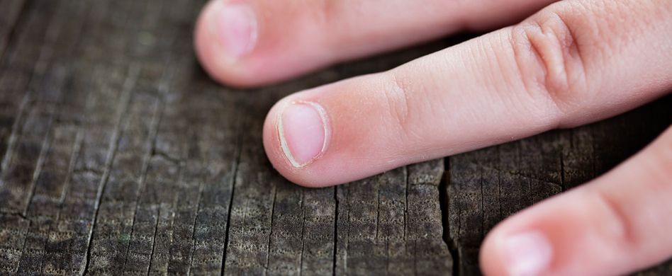 Weiße Flecken auf den Fingernägeln: 3 Ursachen