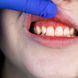 Zahn nicht schuld: Zahnschmerzen durch Zahnfleischentzündung (Gingivitis)