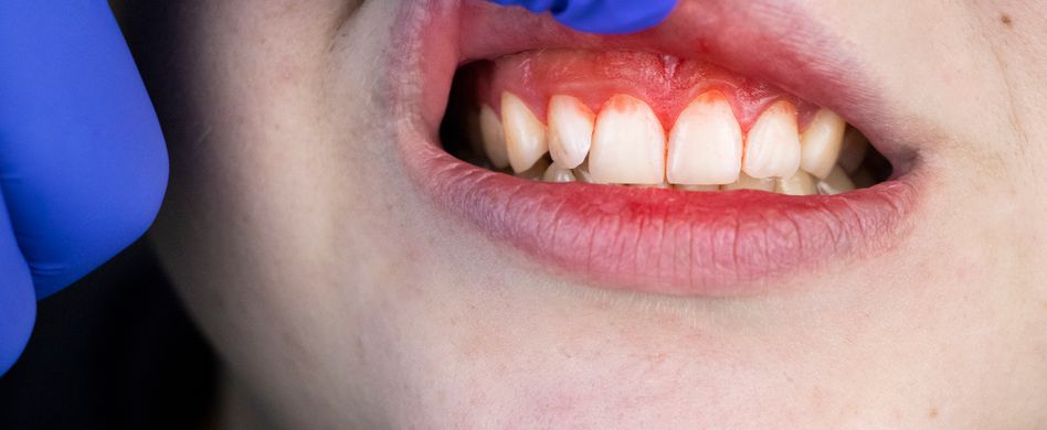 Zahn nicht schuld: Zahnschmerzen durch Zahnfleischentzündung (Gingivitis)
