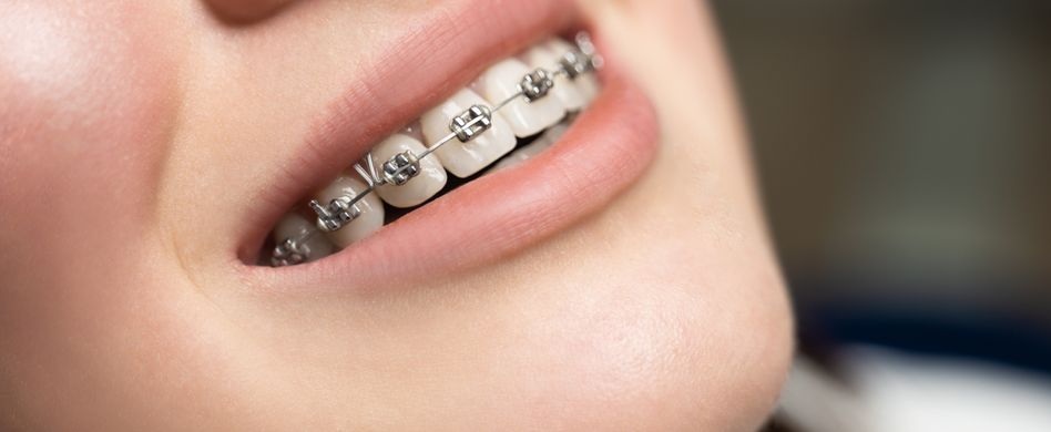Zahn- und Kieferfehlstellungen korrigieren: So behandelt der Kieferorthopäde