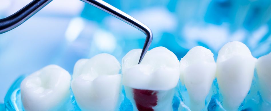 Zahnschmerzen nach Wurzelbehandlung