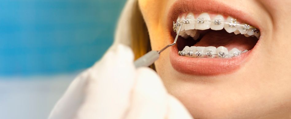 Zahnspange für Erwachsene: Diese Möglichkeiten gibt es